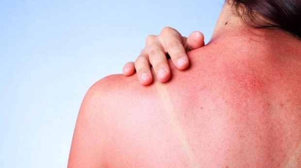 A female touching her sunburned shoulder